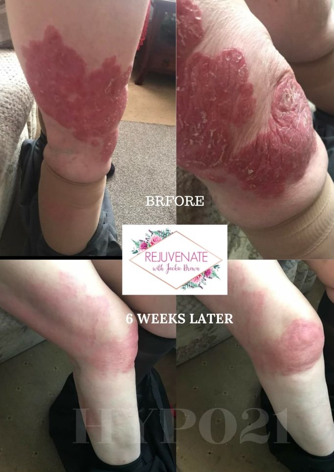 Zwei Vorher-Nachher-Bilder von Beinen mit Psoriasis. Links starke Rötung und Schuppung, rechts nach 6 Wochen deutlich verbessert.